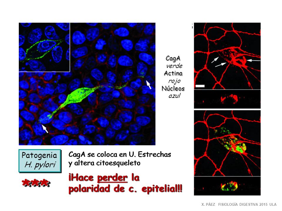 *** ¡Hace perder la polaridad de c. epitelial!! Patogenia H. pylori