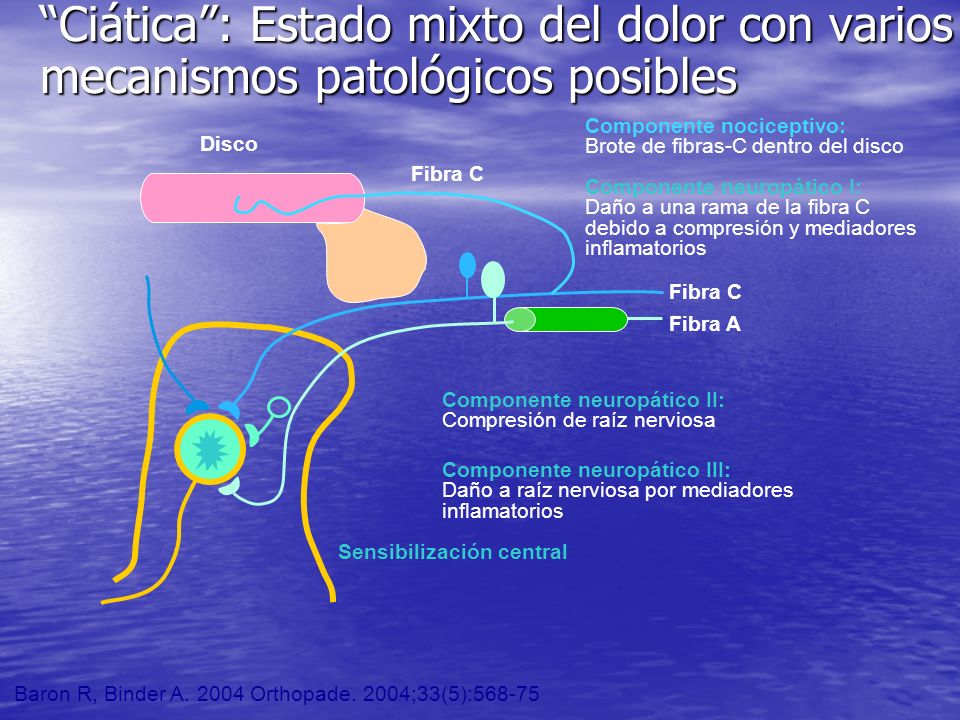 Ciática : Estado mixto del dolor con varios mecanismos patológicos posibles