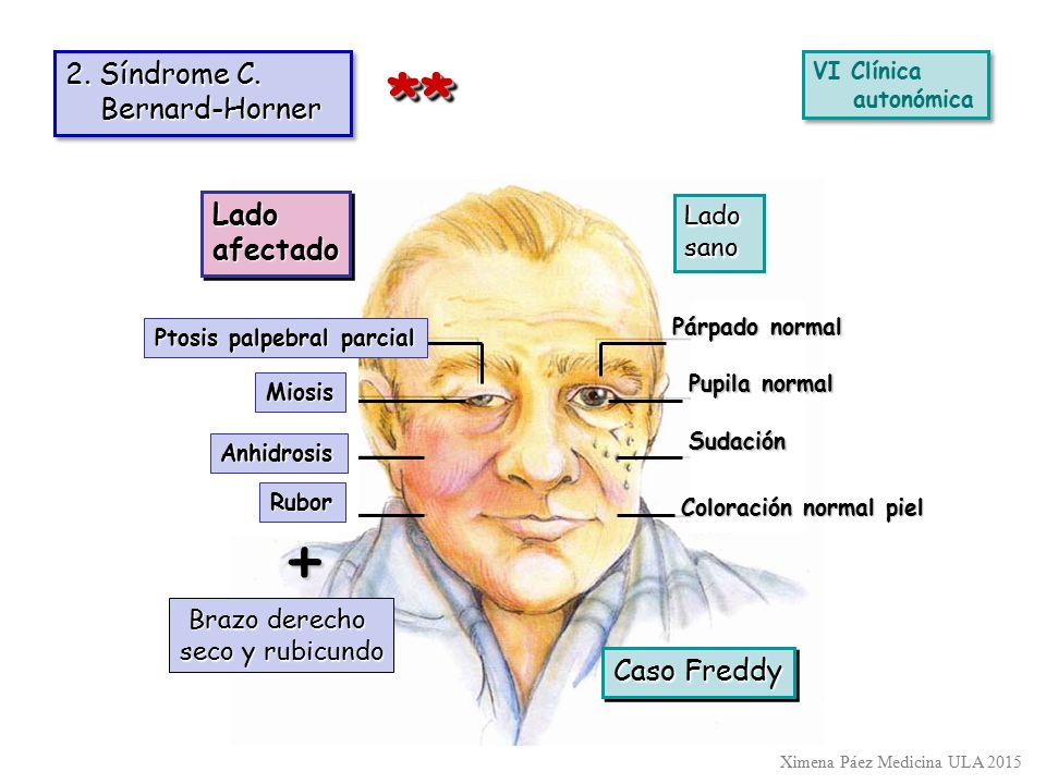+ ** 2. Síndrome C. Bernard-Horner Lado afectado Caso Freddy Lado sano