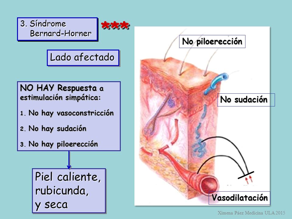 *** Piel caliente, rubicunda, y seca Lado afectado 3. Síndrome