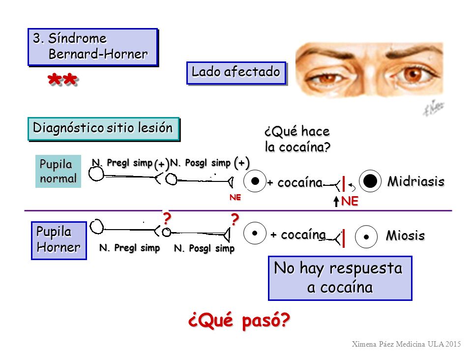 ** ¿Qué pasó No hay respuesta a cocaína 3. Síndrome