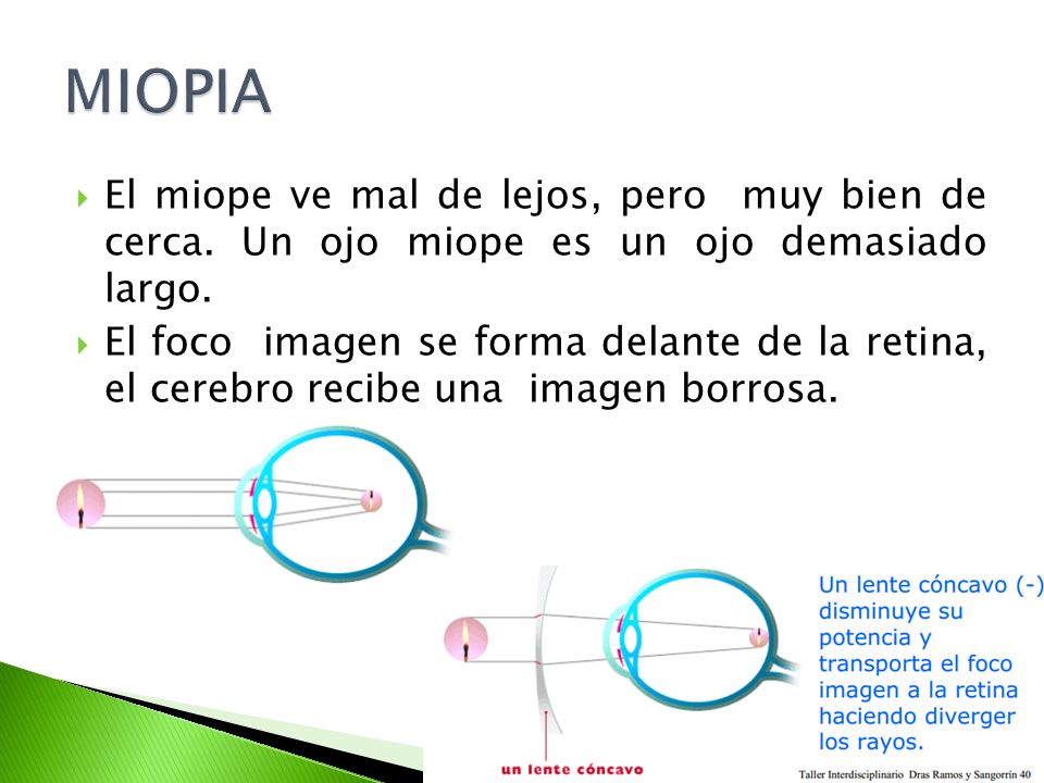 MIOPIA El miope ve mal de lejos, pero muy bien de cerca. Un ojo miope es un ojo demasiado largo.