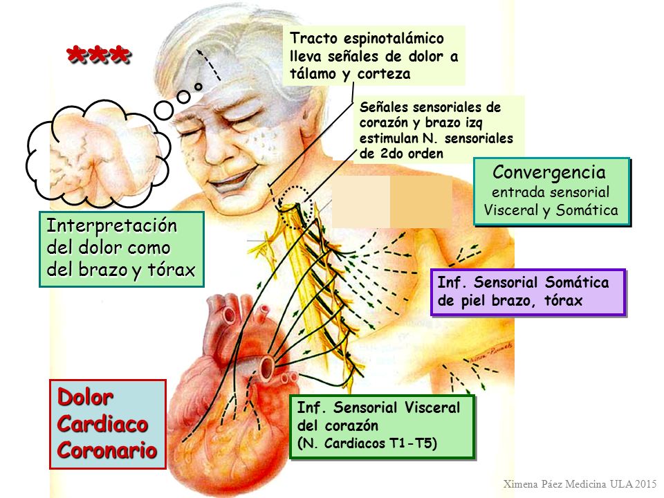 *** Dolor Cardiaco Coronario Convergencia Interpretación