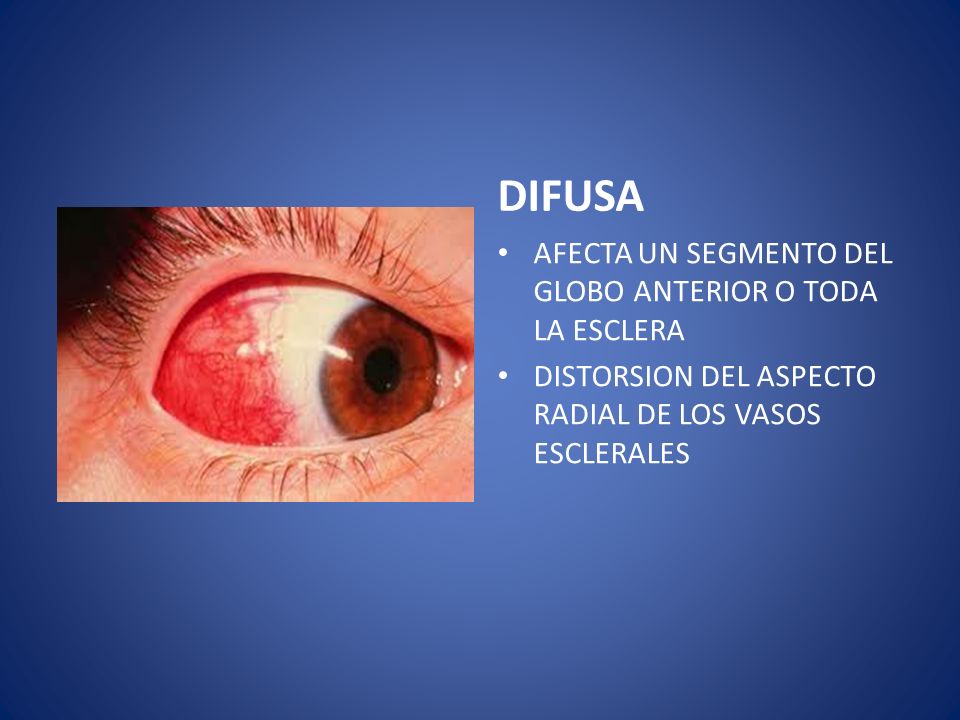 DIFUSA AFECTA UN SEGMENTO DEL GLOBO ANTERIOR O TODA LA ESCLERA