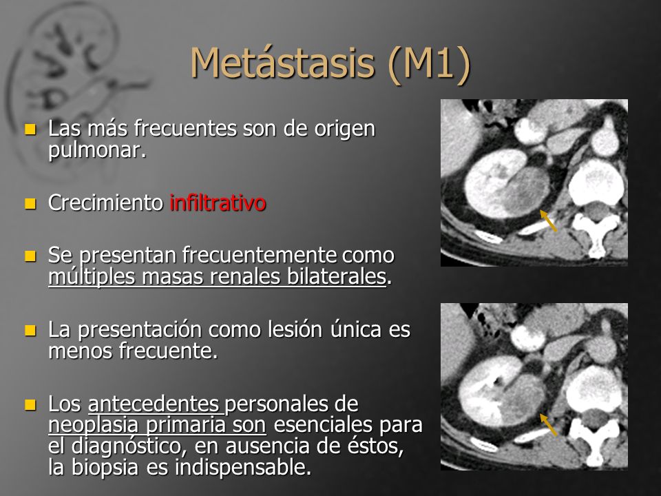 Metástasis (M1) Las más frecuentes son de origen pulmonar.