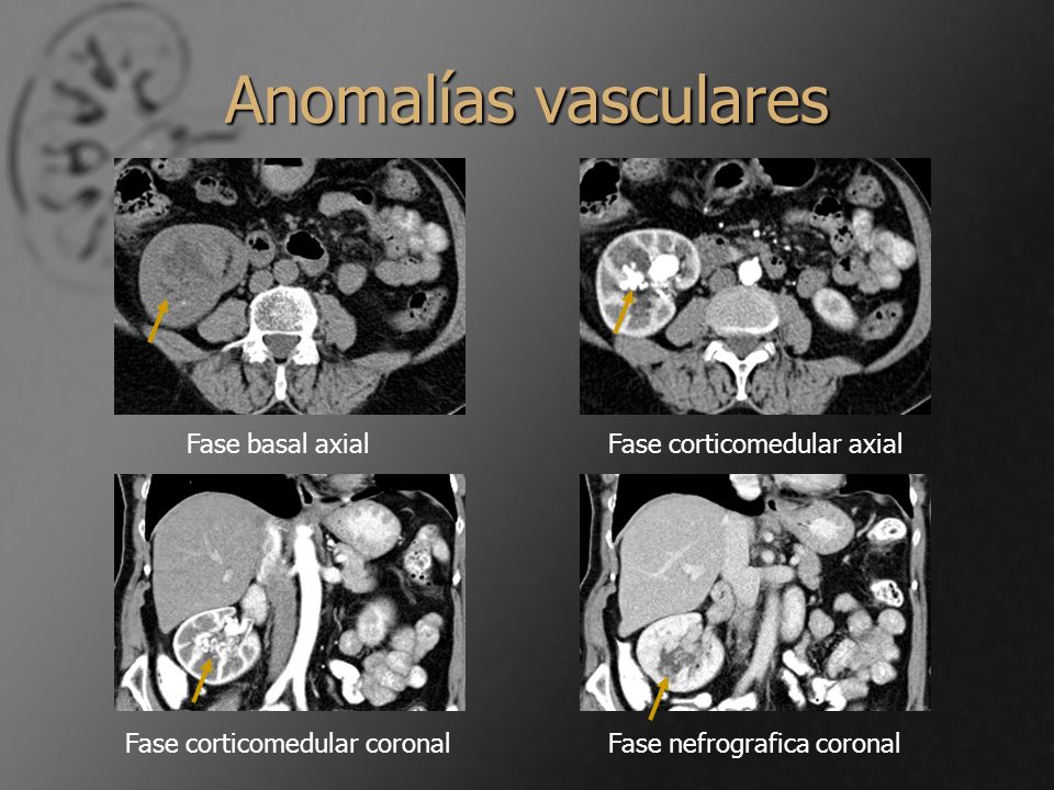 Anomalías vasculares Fase basal axial Fase corticomedular axial
