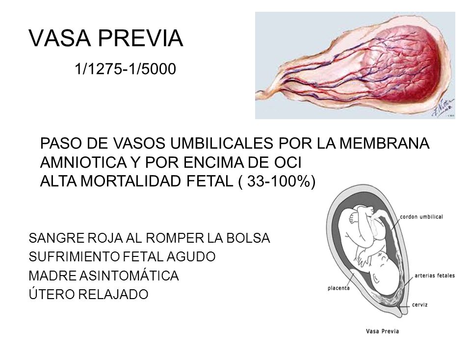 VASA PREVIA 1/1275-1/5000 PASO DE VASOS UMBILICALES POR LA MEMBRANA AMNIOTICA Y POR ENCIMA DE OCI.