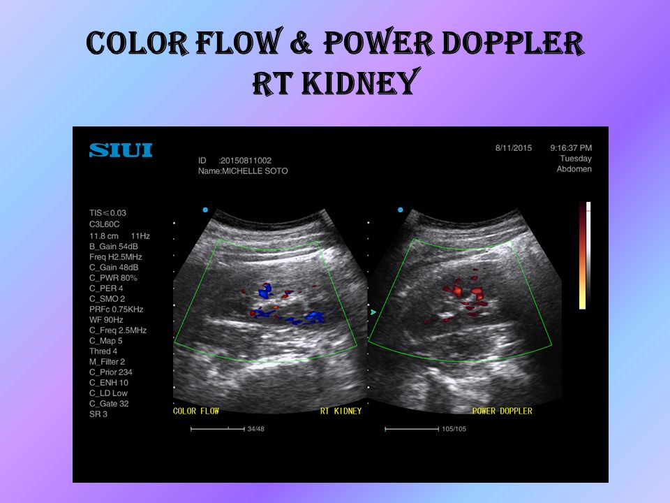 Color flow & power doppler RT Kidney