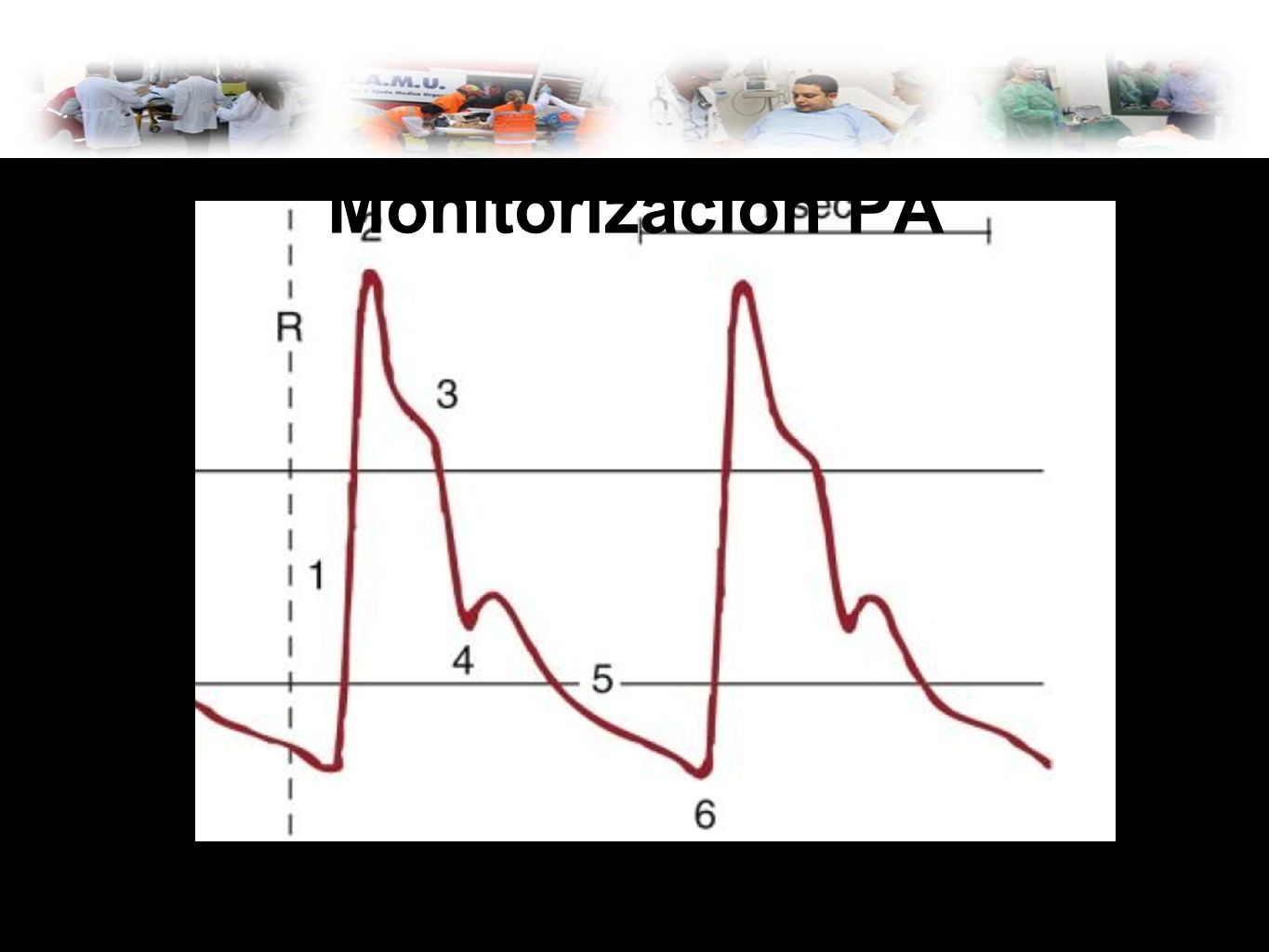 Monitorización PA Onda 3 presión amortiguada por la elasticidad de la arteria