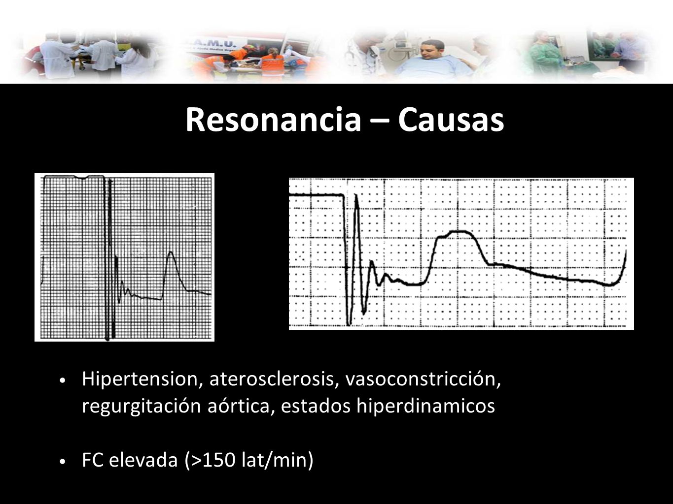Resonancia – Causas Hipertension, aterosclerosis, vasoconstricción, regurgitación aórtica, estados hiperdinamicos.