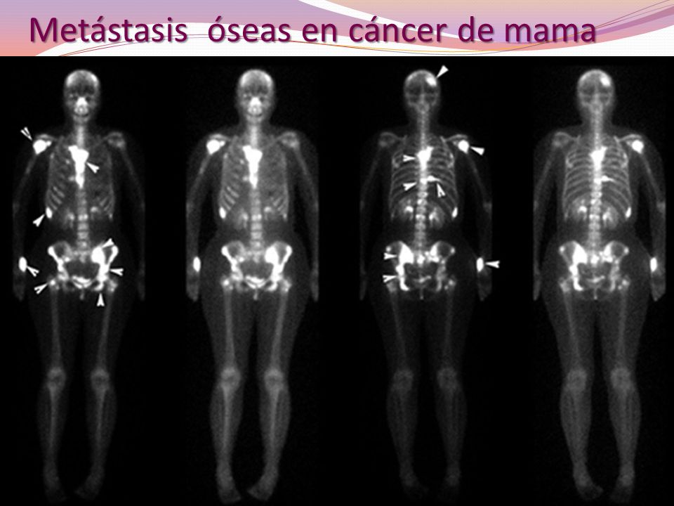 Остеосцинтиграфия при раке молочной железы