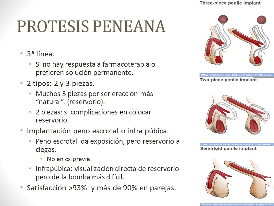 PROTESIS PENEANA 3ª línea. 2 tipos: 2 y 3 piezas.