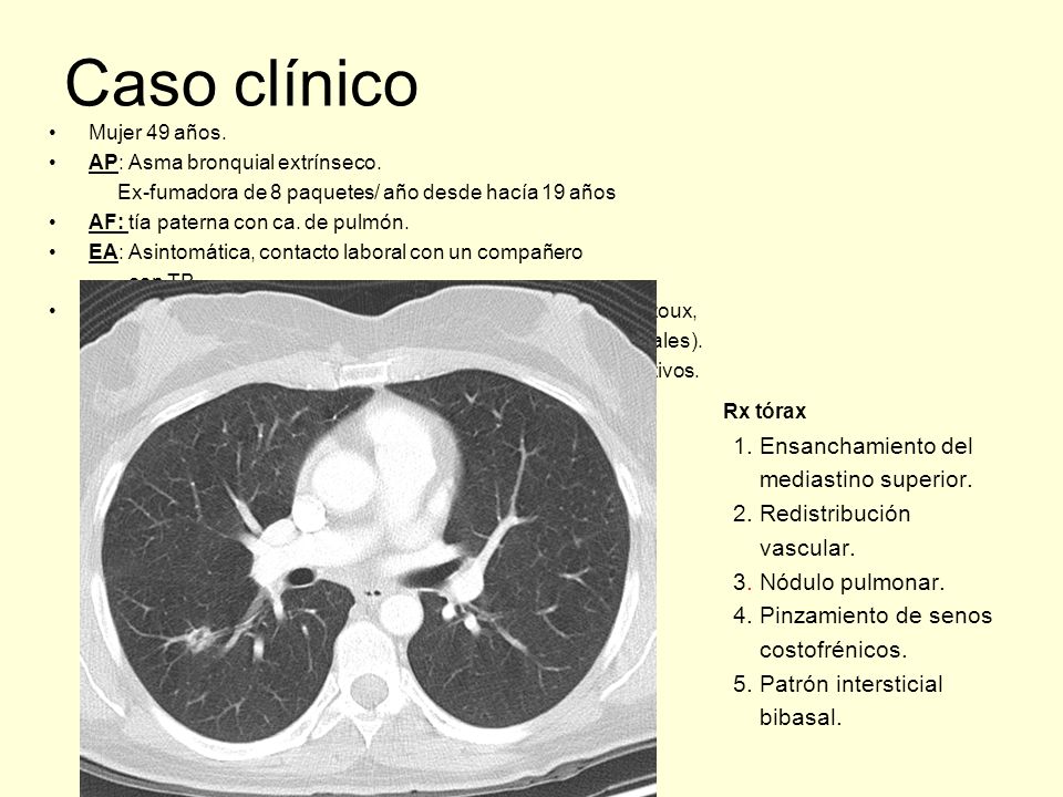 Caso clínico Rx tórax 1. Ensanchamiento del mediastino superior.
