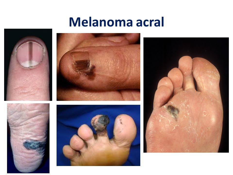 Melanoma acral