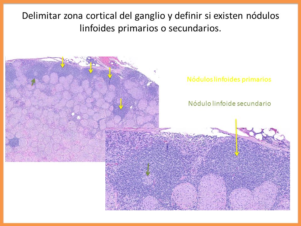 Delimitar zona cortical del ganglio y definir si existen nódulos linfoides primarios o secundarios.