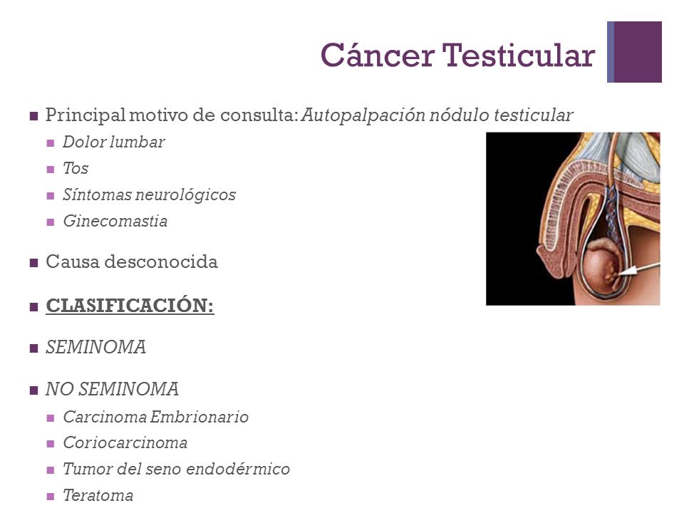Cáncer Testicular Principal motivo de consulta: Autopalpación nódulo testicular. Dolor lumbar. Tos.