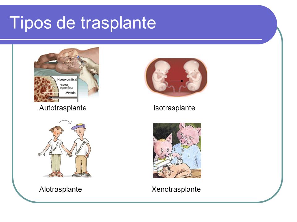 Tipos de trasplante Autotrasplante isotrasplante Alotrasplante