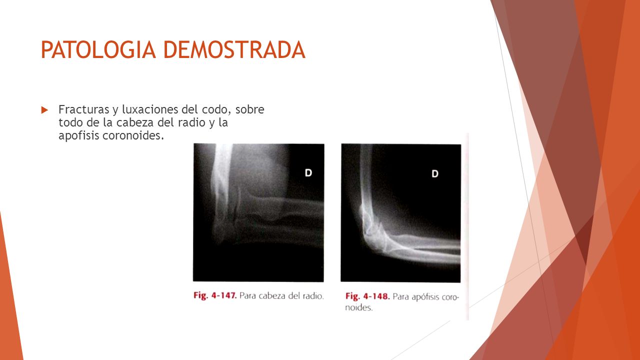 PATOLOGIA DEMOSTRADA Fracturas y luxaciones del codo, sobre todo de la cabeza del radio y la apofisis coronoides.