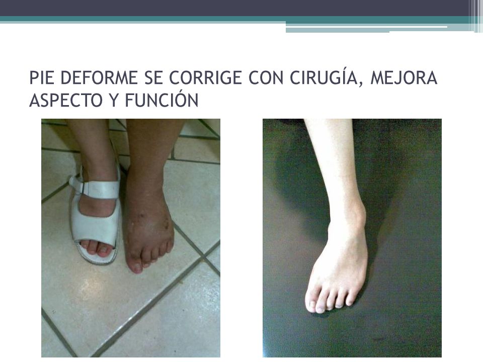 PIE DEFORME SE CORRIGE CON CIRUGÍA, MEJORA ASPECTO Y FUNCIÓN