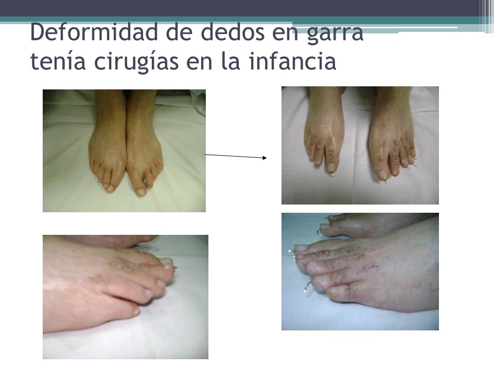 Deformidad de dedos en garra tenía cirugías en la infancia