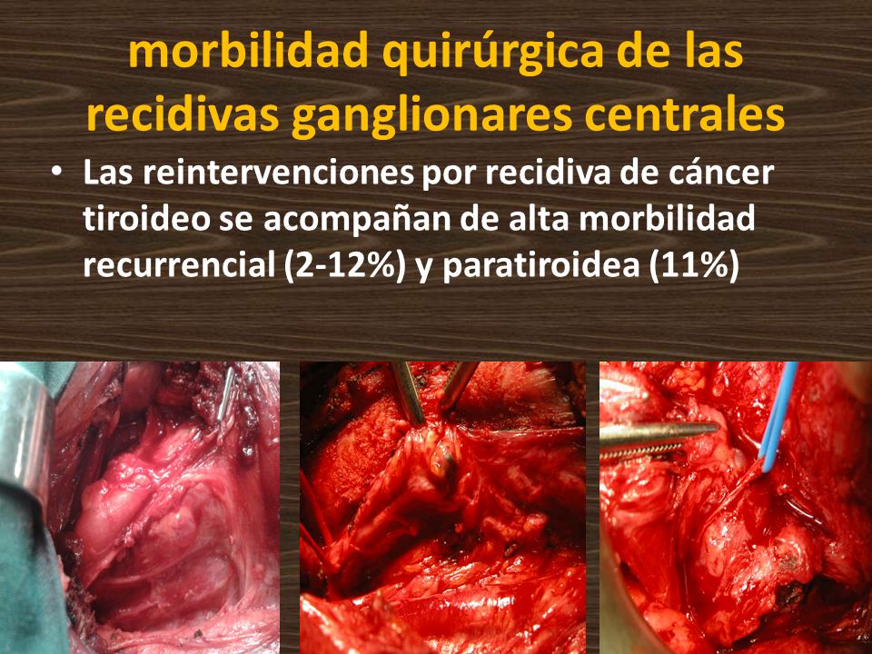 morbilidad quirúrgica de las recidivas ganglionares centrales
