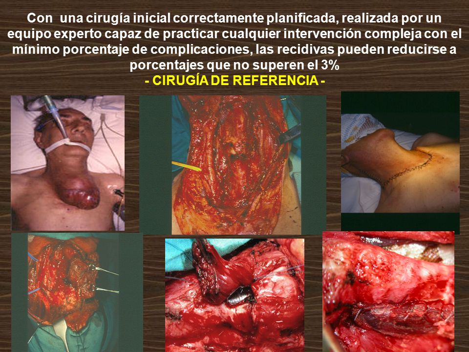 Con una cirugía inicial correctamente planificada, realizada por un equipo experto capaz de practicar cualquier intervención compleja con el mínimo porcentaje de complicaciones, las recidivas pueden reducirse a porcentajes que no superen el 3% - CIRUGÍA DE REFERENCIA -