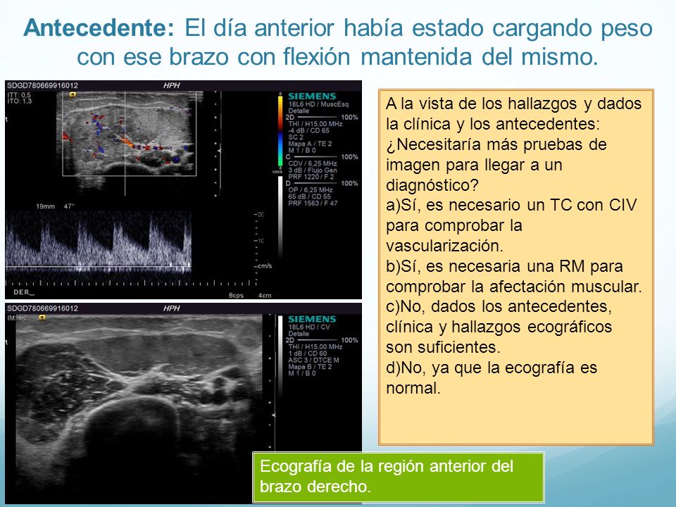 Antecedente: El día anterior había estado cargando peso con ese brazo con flexión mantenida del mismo.