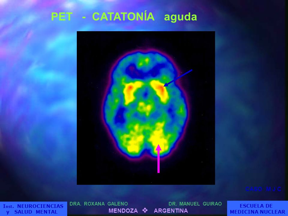 PET - CATATONÍA aguda CASO M J C ESCUELA DE MENDOZA v ARGENTINA