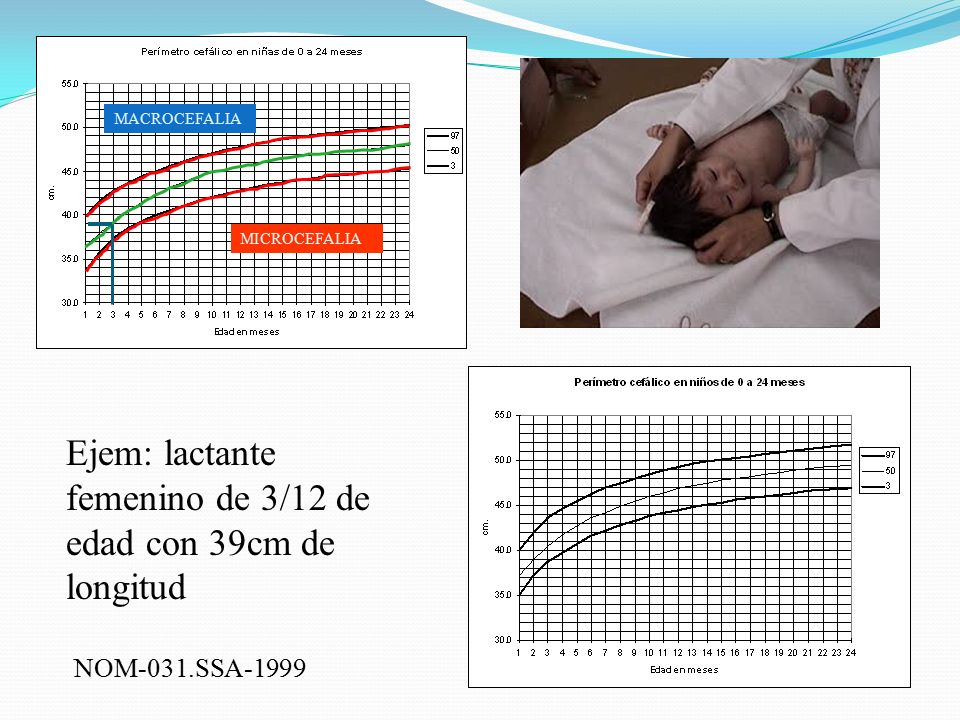 Ejem: lactante femenino de 3/12 de edad con 39cm de longitud