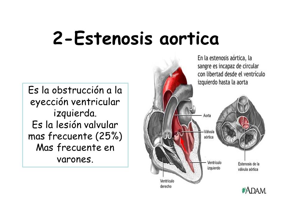 2-Estenosis aortica Es la obstrucción a la eyección ventricular izquierda. Es la lesión valvular mas frecuente (25%)