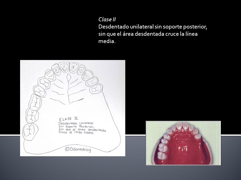 Clase II Desdentado unilateral sin soporte posterior, sin que el área desdentada cruce la línea media.