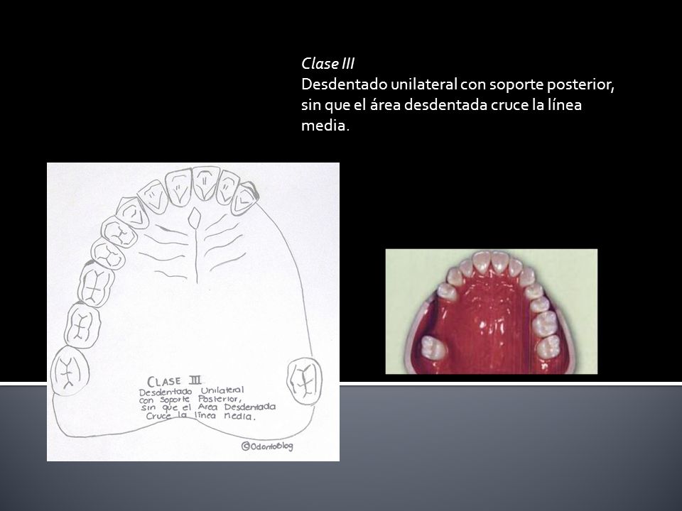 Clase III Desdentado unilateral con soporte posterior, sin que el área desdentada cruce la línea media.