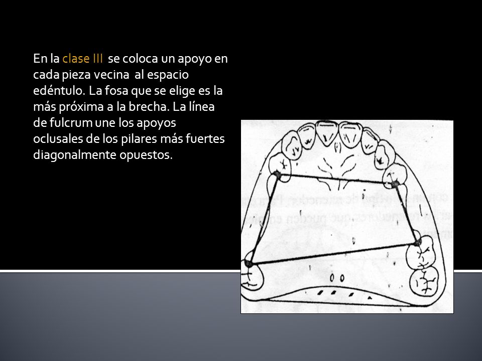 En la clase III se coloca un apoyo en cada pieza vecina al espacio edéntulo.