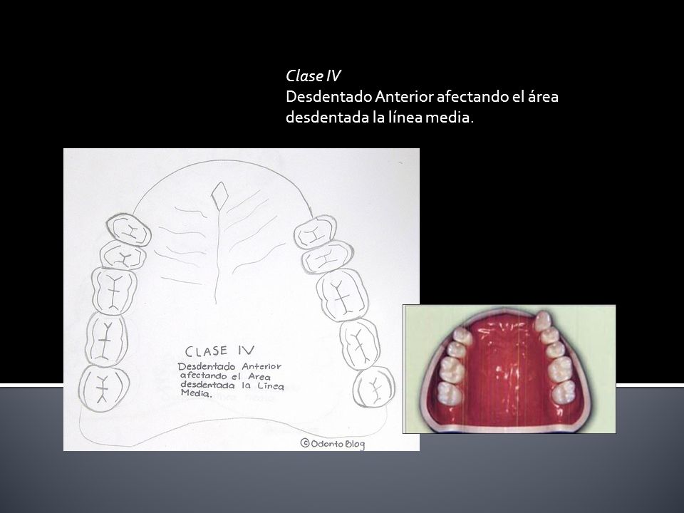 Clase IV Desdentado Anterior afectando el área desdentada la línea media.