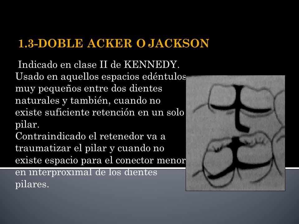 1.3-DOBLE ACKER O JACKSON Indicado en clase II de KENNEDY.