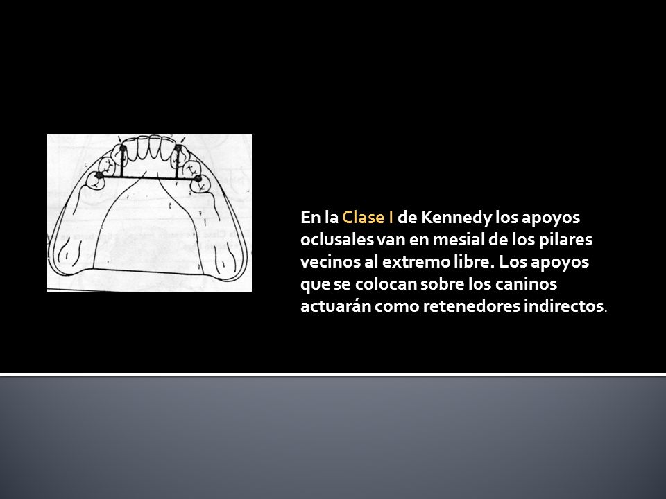 En la Clase I de Kennedy los apoyos oclusales van en mesial de los pilares vecinos al extremo libre.