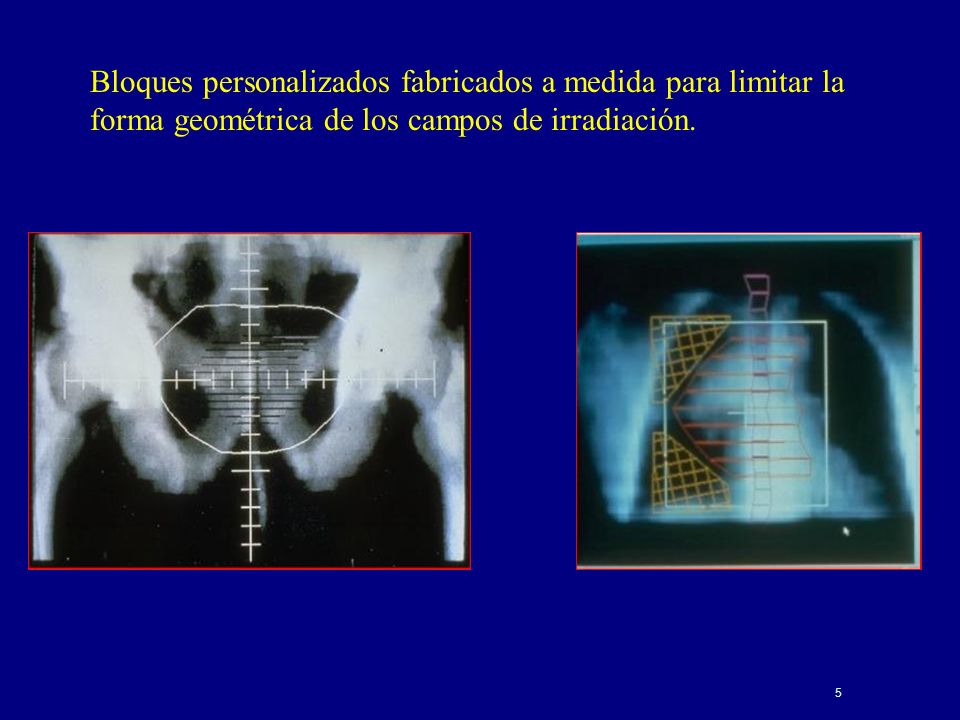 Bloques personalizados fabricados a medida para limitar la forma geométrica de los campos de irradiación.
