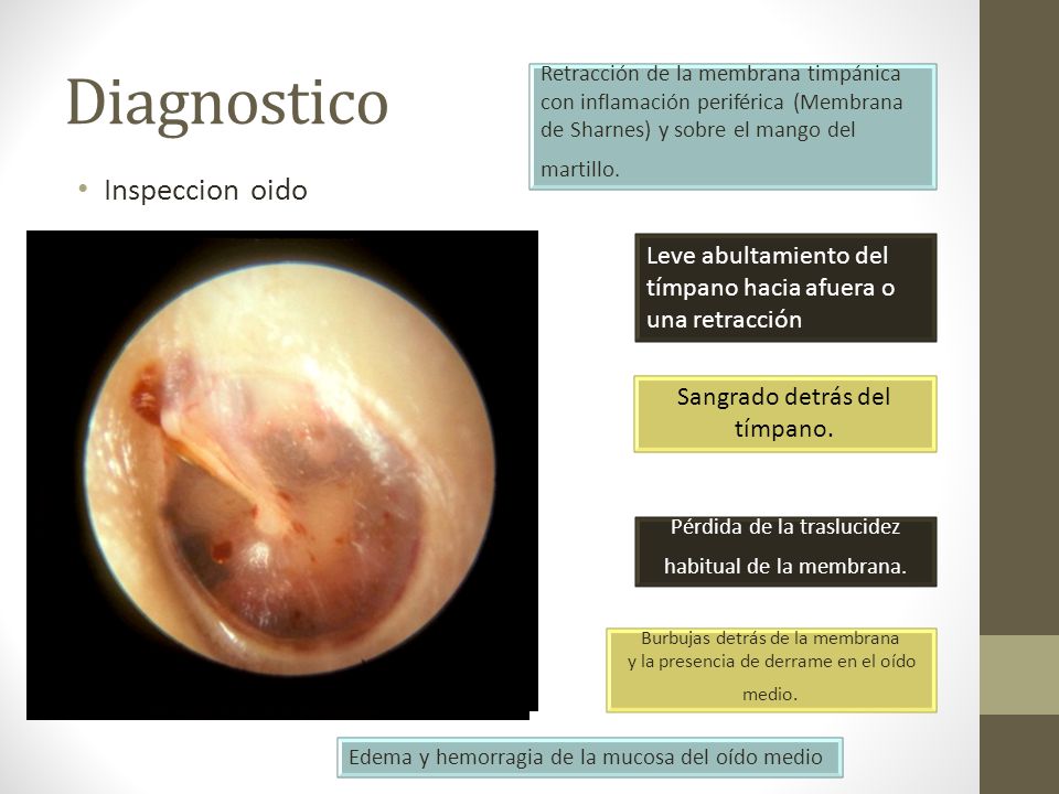 Diagnostico Retracción de la membrana timpánica con inflamación periférica (Membrana de Sharnes) y sobre el mango del martillo.