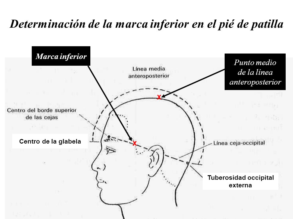 Determinación de la marca inferior en el pié de patilla