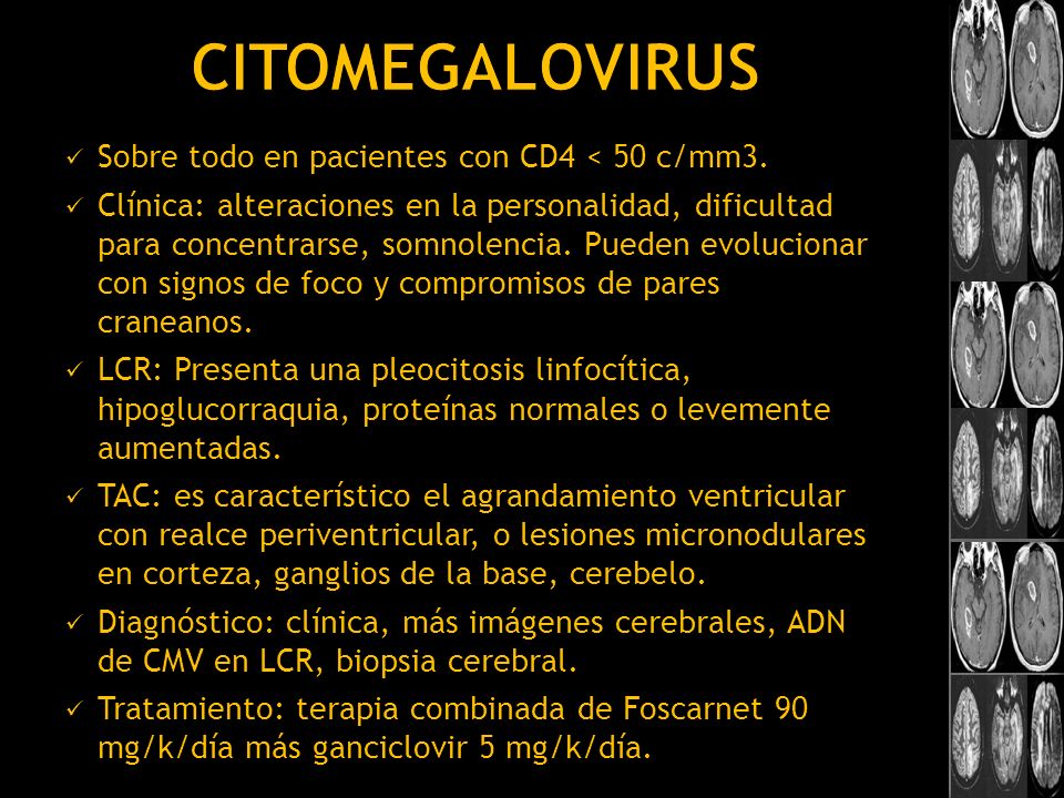 Citomegalovirus Sobre todo en pacientes con CD4 < 50 c/mm3.