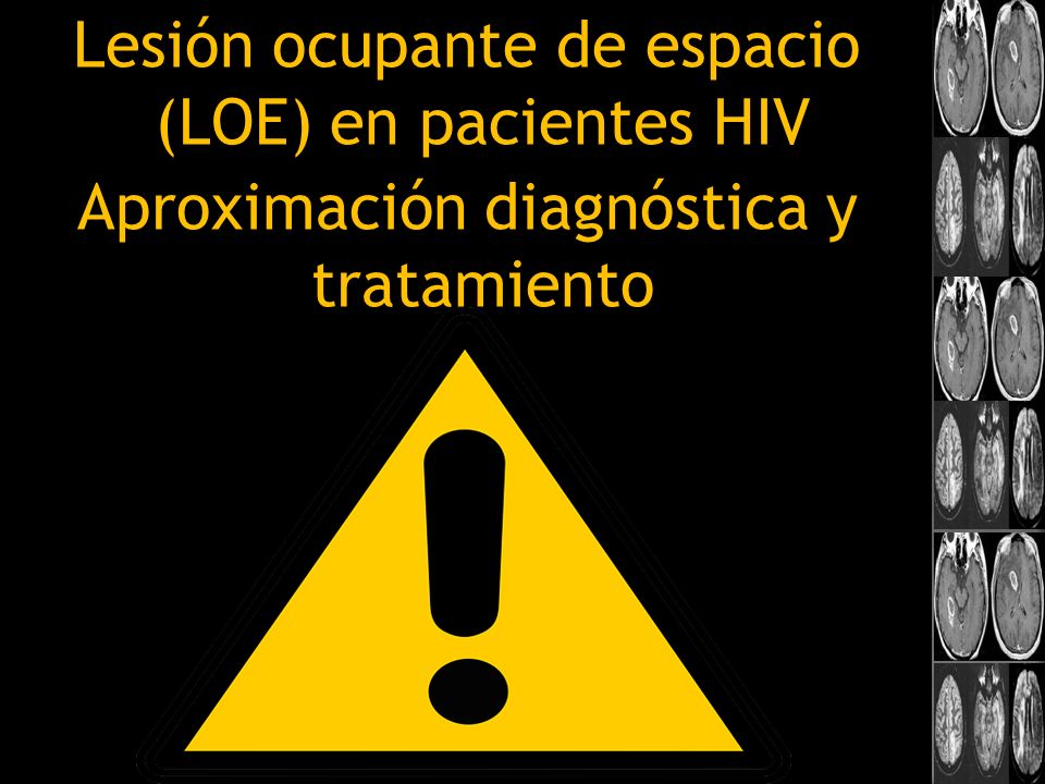 Lesión ocupante de espacio (LOE) en pacientes HIV Aproximación diagnóstica y tratamiento
