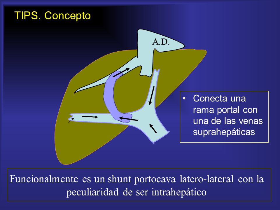 TIPS. Concepto A.D. Conecta una rama portal con una de las venas suprahepáticas.