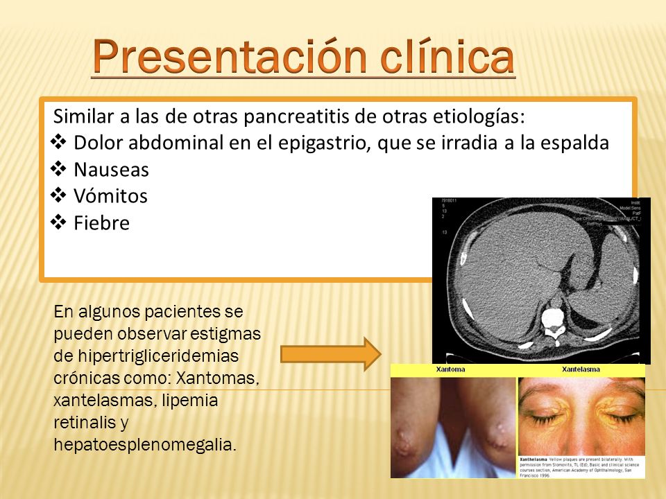 Presentación clínica Similar a las de otras pancreatitis de otras etiologías: Dolor abdominal en el epigastrio, que se irradia a la espalda.
