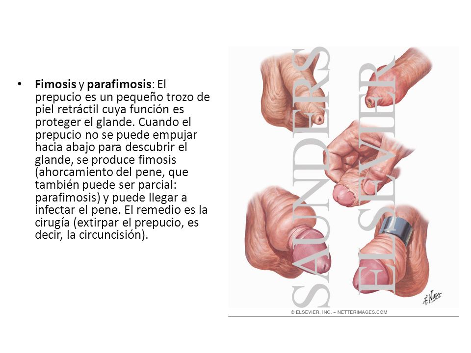 Fimosis y parafimosis: El prepucio es un pequeño trozo de piel retráctil cuya función es proteger el glande.