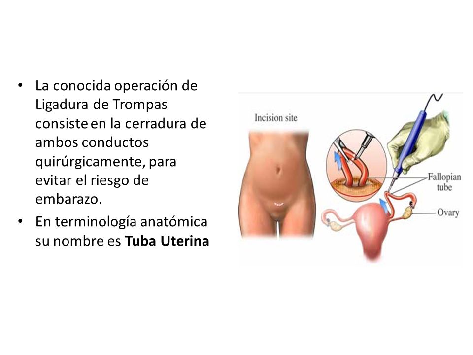 La conocida operación de Ligadura de Trompas consiste en la cerradura de ambos conductos quirúrgicamente, para evitar el riesgo de embarazo.