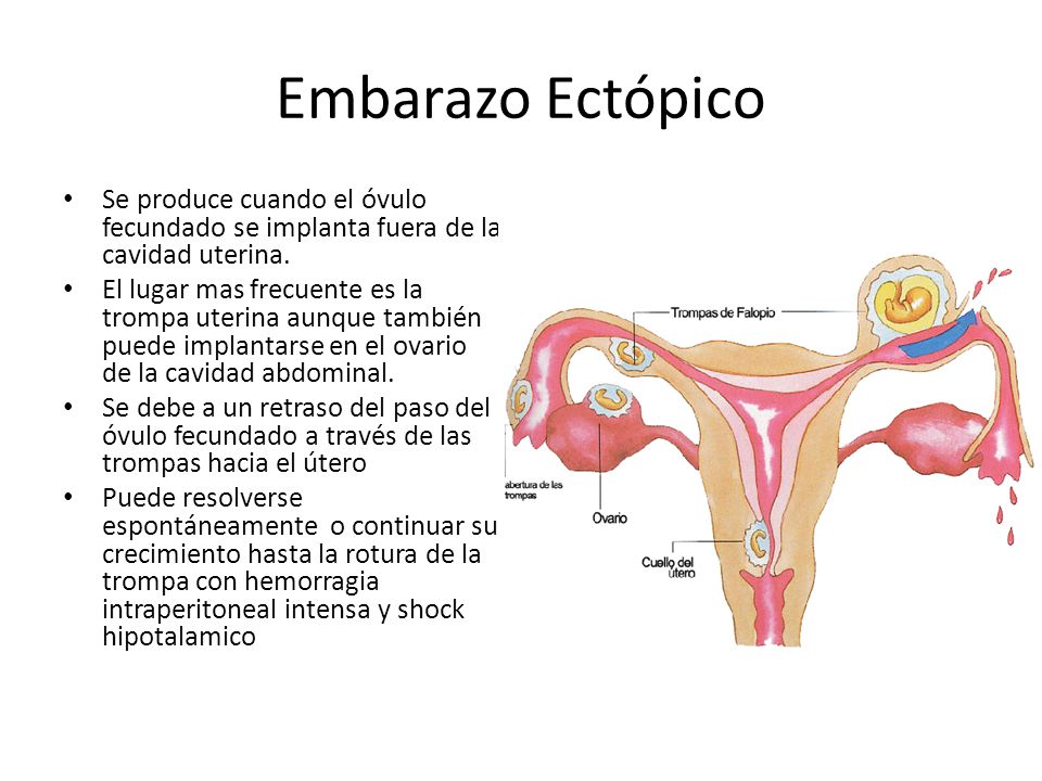 Embarazo Ectópico Se produce cuando el óvulo fecundado se implanta fuera de la cavidad uterina.