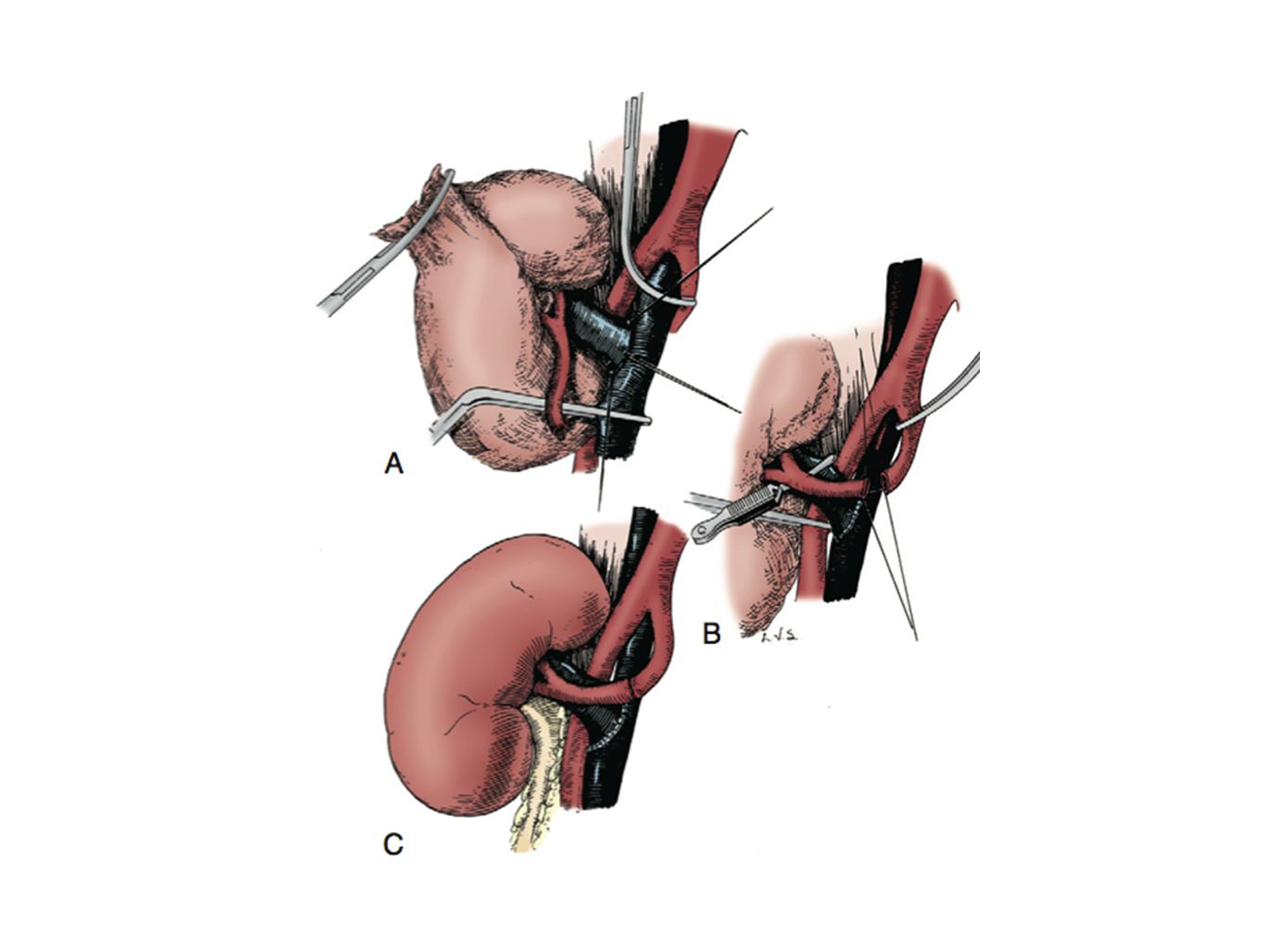 The renal vein is anastomosed to the external iliac vein, usually medial to the external iliac artery. When the recipient has a tortuous iliac artery, the venous anastomosis is best performed lateral to the bowed external iliac artery. B, In the absence of significant recipient arteriosclerosis, the renal artery is commonly anastomosed to the internal iliac artery with 5-0 or 6-0 monofilament, nonabsorbable sutures. Many prefer to perform the renal artery anastomosis before the venous anastomosis. If significant internal iliac arteriosclerosis is present or the contralateral renal artery has been used in a previous renal transplant in a man, the external or common iliac arteries become the target vessels for renal artery anastomosis. C, The completed venous and arterial anastomoses.
