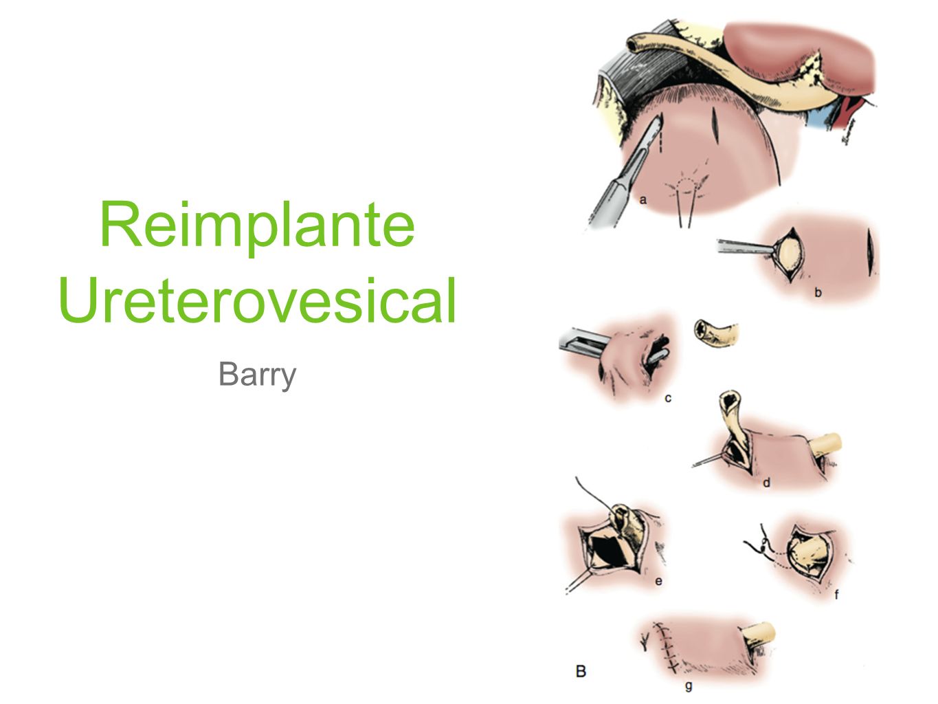 Reimplante Ureterovesical