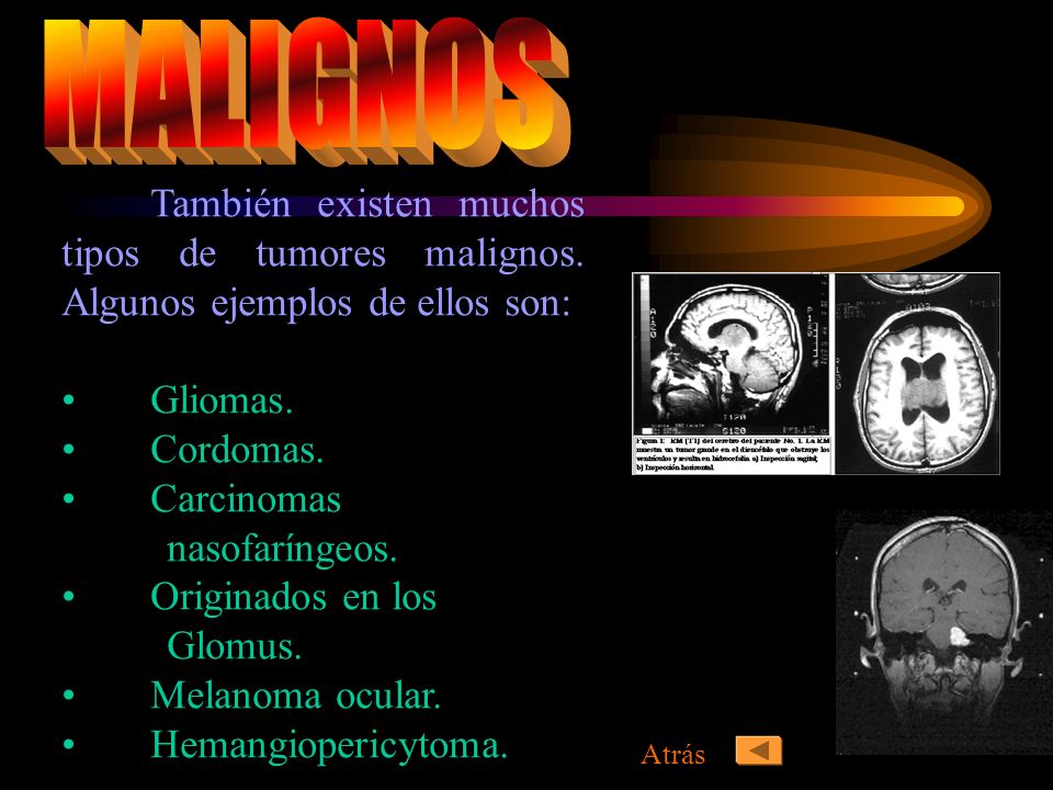 MALIGNOS También existen muchos tipos de tumores malignos. Algunos ejemplos de ellos son: Gliomas.