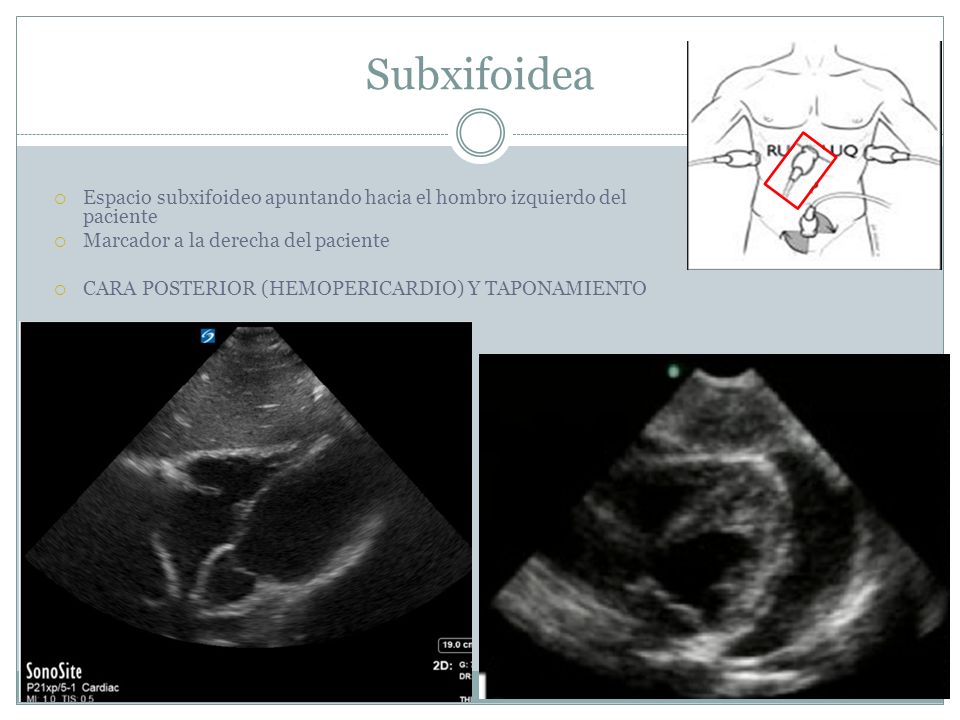 Subxifoidea Espacio subxifoideo apuntando hacia el hombro izquierdo del paciente. Marcador a la derecha del paciente.